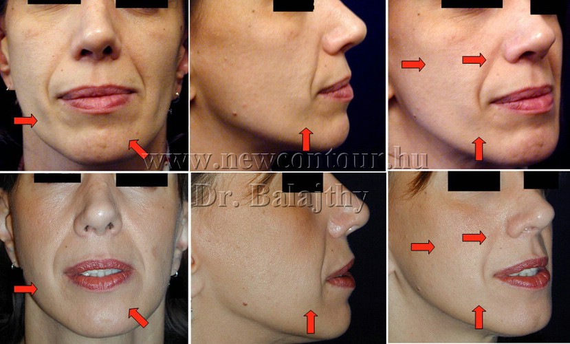 A Dr. Goodwinnál elérhető hialuronsavas arcfeltöltés kezelések
