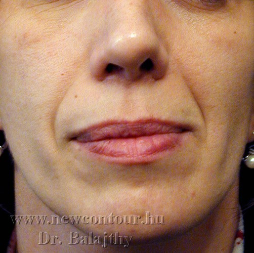 Botox ránctalanítás - dr. Pataki Gergely plasztikai sebész