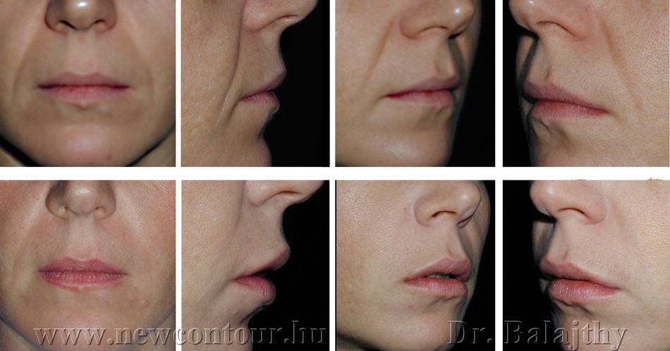 Botox, hialuronsav feltöltés után - dr. Bulyovszky István, PERFECT YOU Plasztikai Sebészet